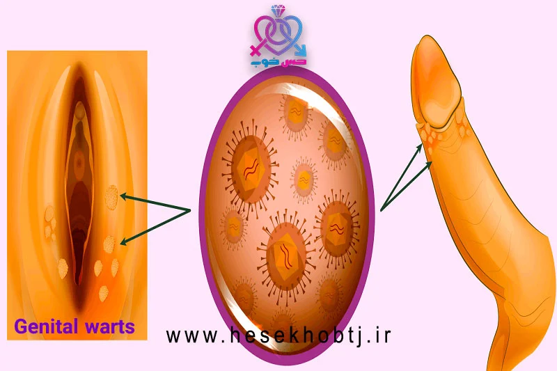درمان زگیل تناسلی